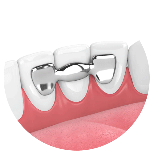 Dental Bridges