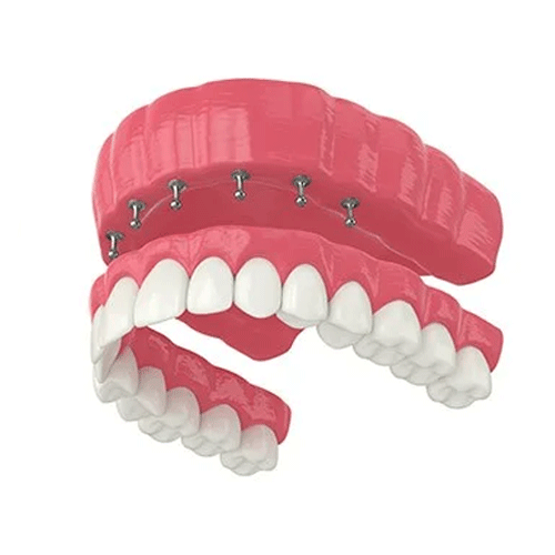 Dental Bridges