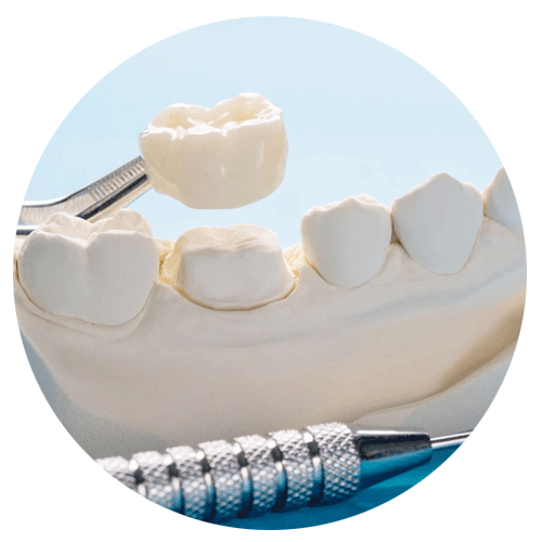Dental Bridges