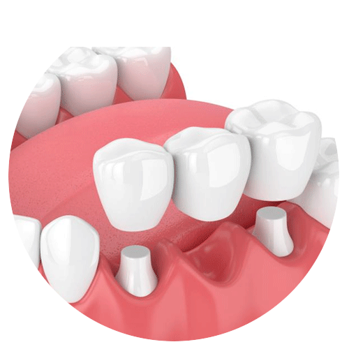 Dental Bridges