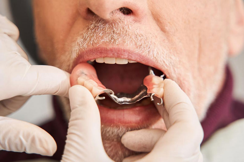 Dentures