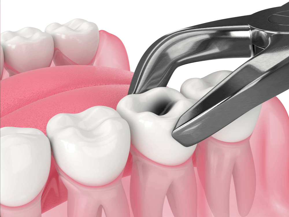 Tooth Extractions
